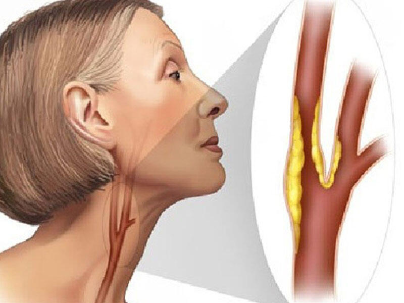 Атеросклеротическая бляшка в сонной артерии. Атеросклероз сосудов шеи.